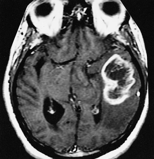 MRI section of the brain showing a ring-enhancing tumour in one hemisphere.