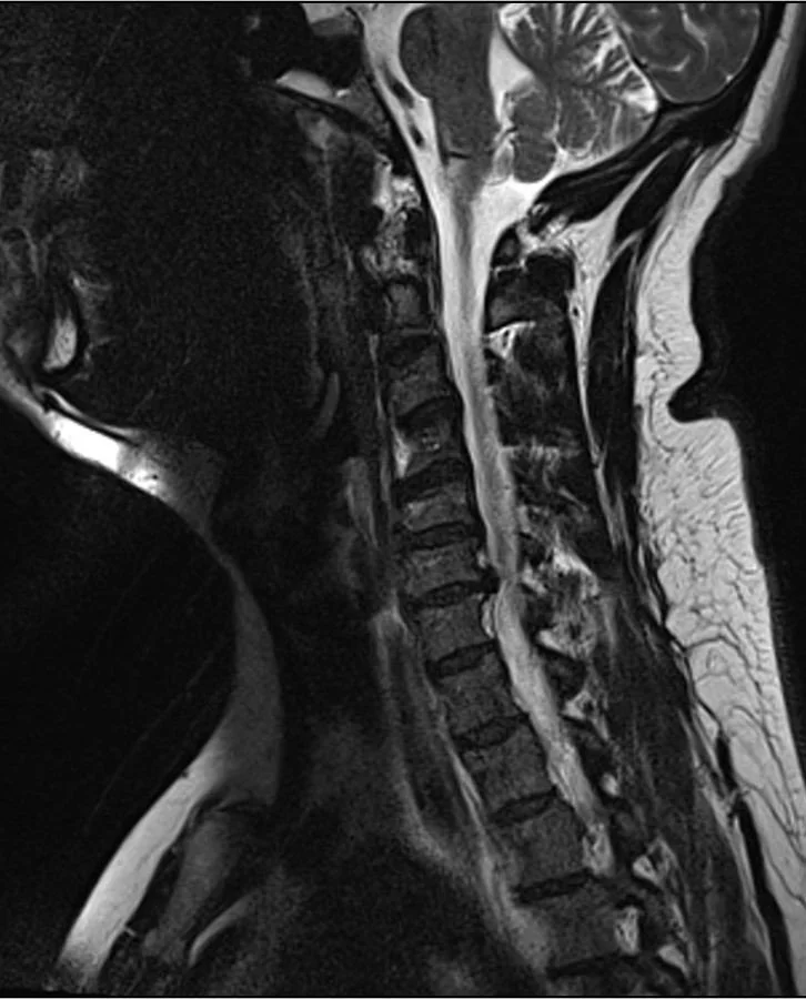 Side-view MRI of the cervical spine with a bulging disc between C6 and C7.