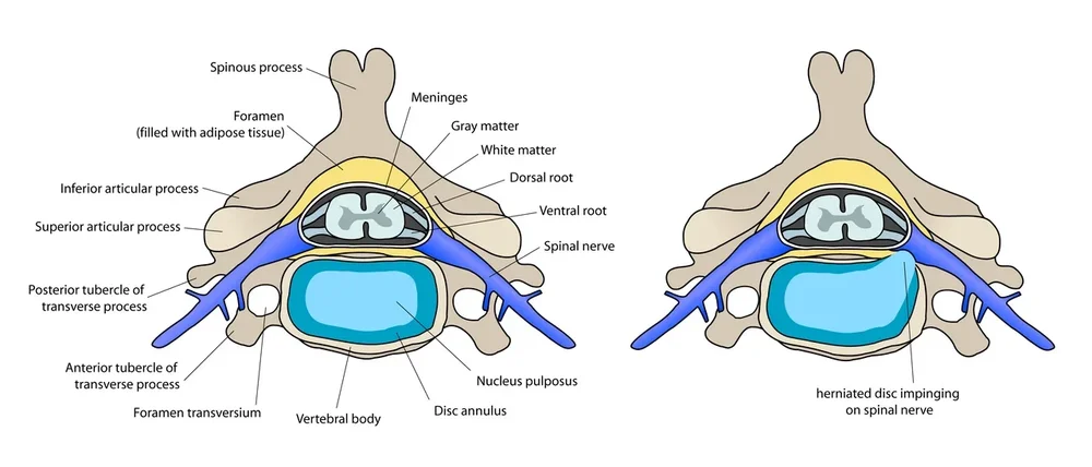 Two cross-sections of a cervical vertebra: on the left normal, on the right a disc pressing against the exiting nerve root.