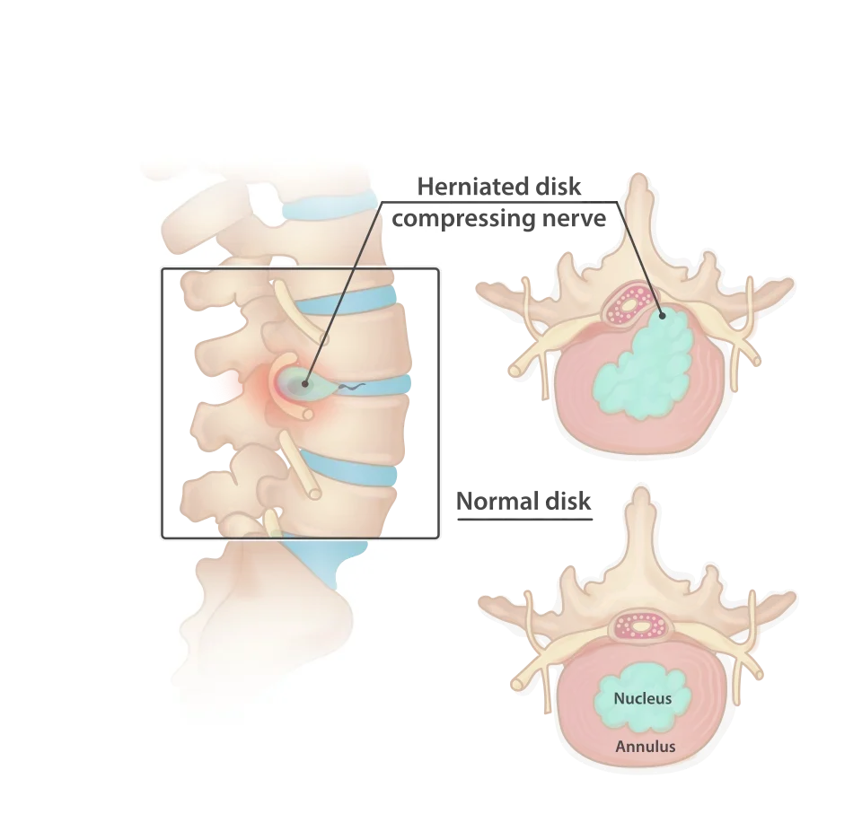 Drawing of the lower back with a bulging intervertebral disc pressing on a nerve, next to a healthy disc.