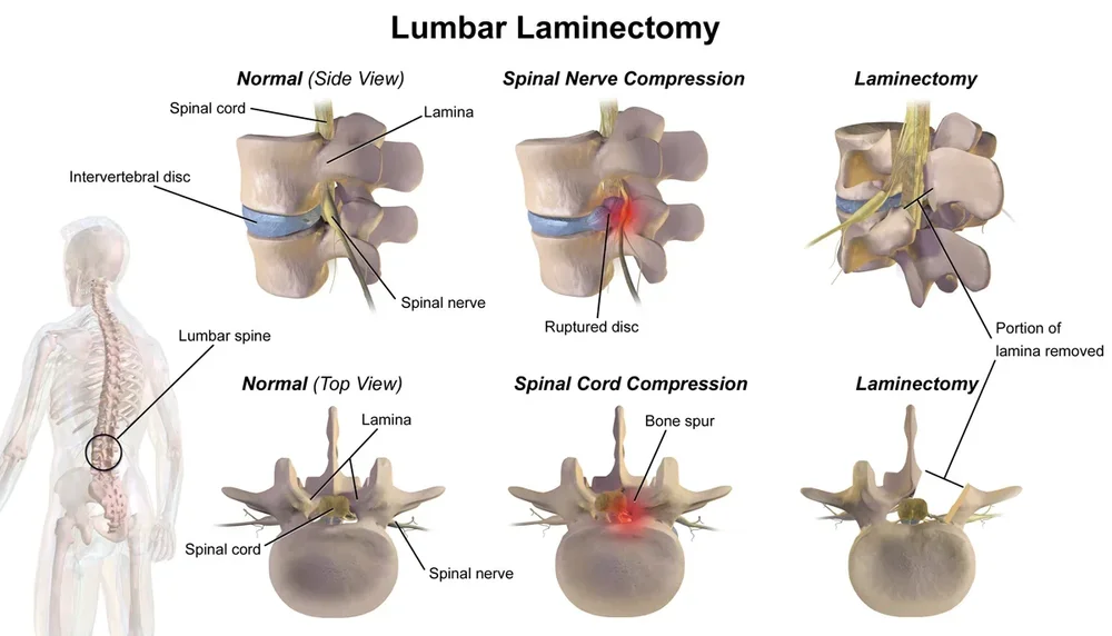 Illustration d'une vertèbre normale, d'une vertèbre avec compression nerveuse et d'une vertèbre après laminectomie, vues de profil et de dessus.