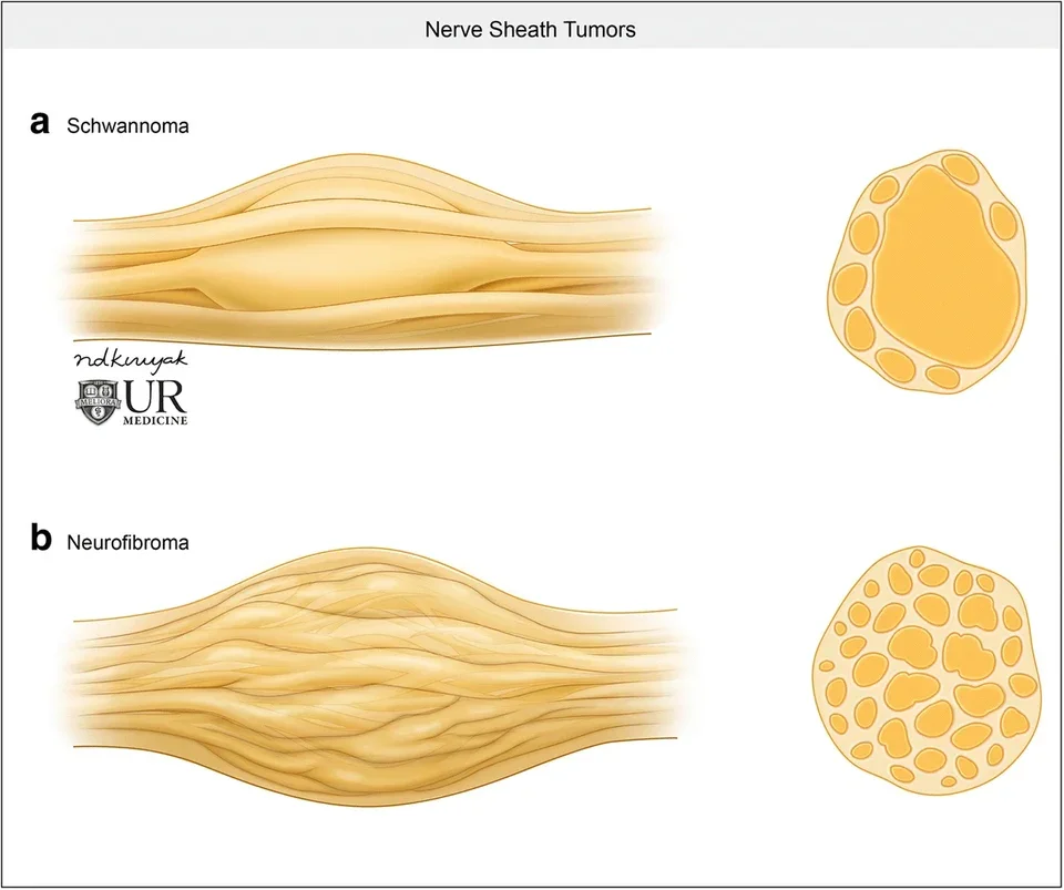 Drawing of two nerve tumours: at the top a schwannoma beside the nerve, at the bottom a neurofibroma growing through the nerve, each with a cross-section.