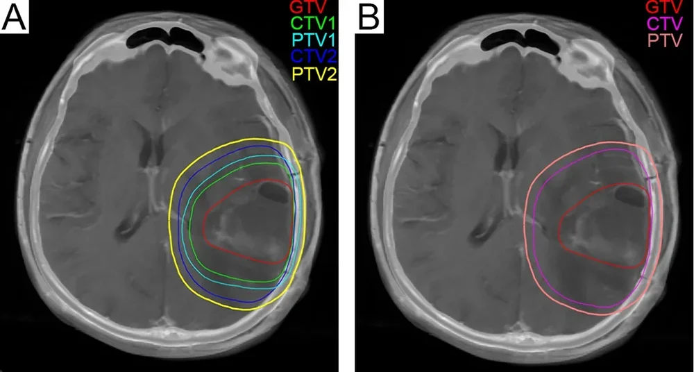 Two CT sections of the brain with coloured contour lines of a radiotherapy plan around a tumour cavity.