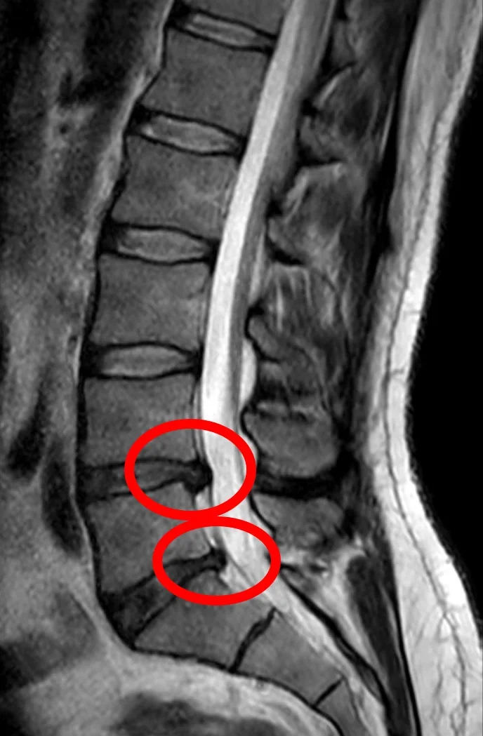 Side-view MRI of the lumbar spine with red circles around two bulging intervertebral discs.