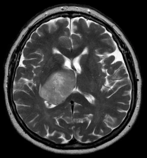 Coupe IRM du cerveau montrant une anomalie située profondément dans le cerveau.
