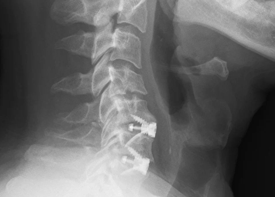Side-view X-ray of the cervical spine with an interbody cage after fusion.