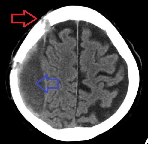 Coupe de scanner de la tête montrant un hématome sous-dural chronique (flèche bleue) et un trou de trépan (flèche rouge).