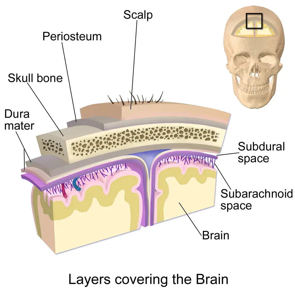 Cross-section of scalp, skull, dura and brain, with the spaces between the membranes indicated.