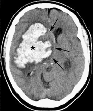 Coupe de scanner du cerveau montrant une grande hémorragie blanche en profondeur dans un hémisphère, signalée par un astérisque et des flèches.
