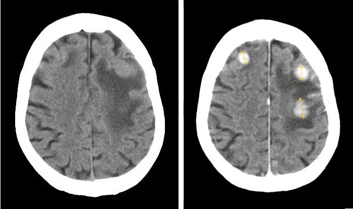 Two CT sections of the brain; on the right one, with contrast, three round white metastases can be seen.