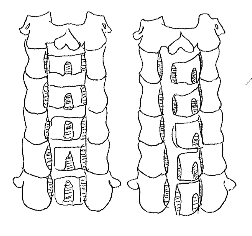 Dessin au trait de la colonne cervicale vue de l'arrière, avant et après une laminoplastie en porte ouverte.