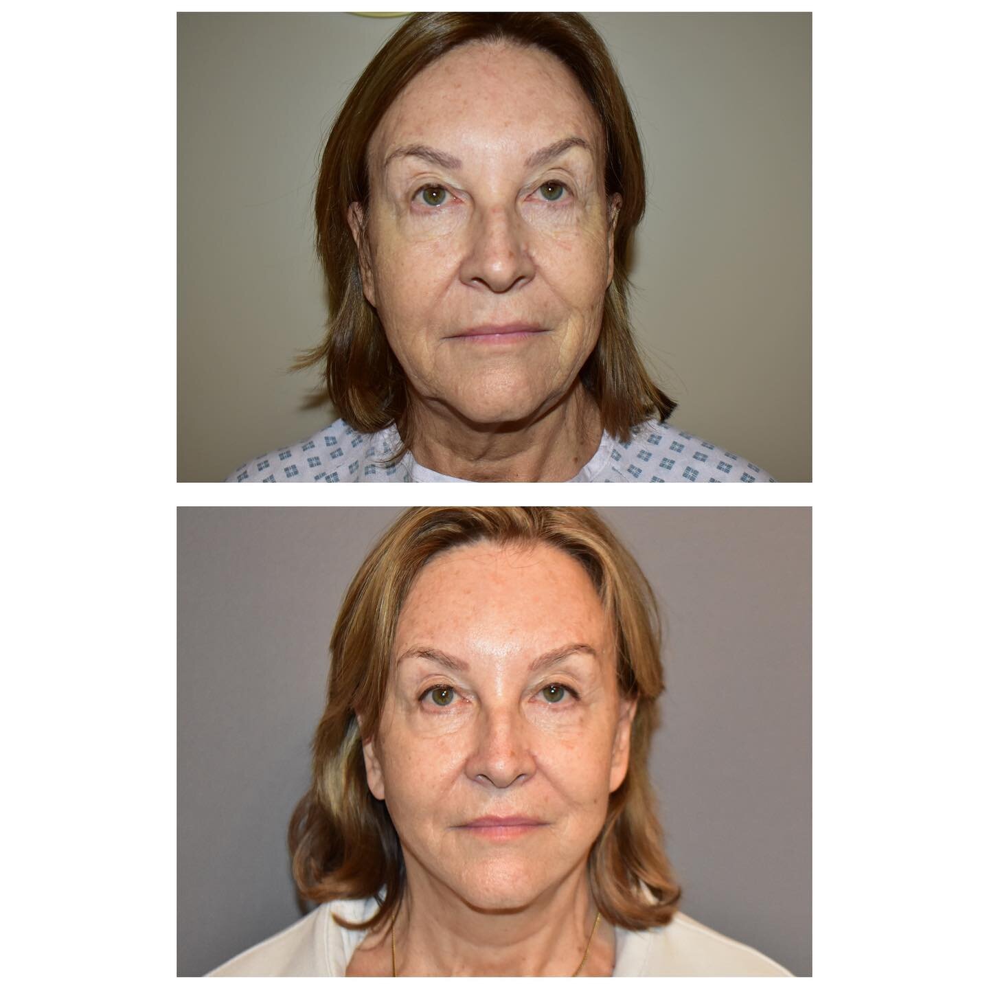 Facelift procedure.

As you can see from the above images before and 6 weeks after surgery that a facelift is very natural looking taking years off your neck, jawline and cheeks.

If you want a consultation for this procedure you can email Mr Carver 