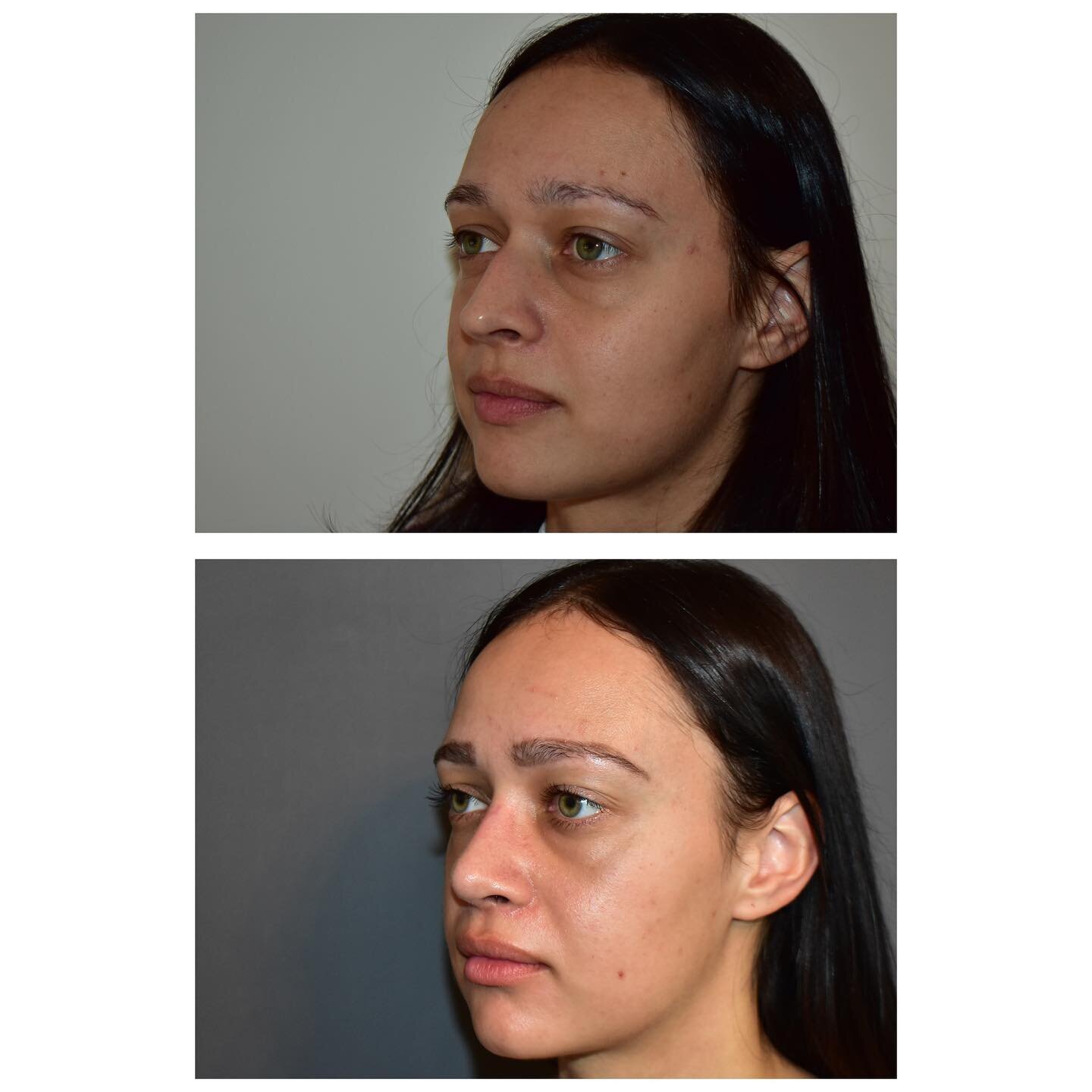 Another fantastic result of a Rhinoplasty carried out by Mr Carver.

Please contact Sky on sky@nigelcarver.co.uk for all enquiries.