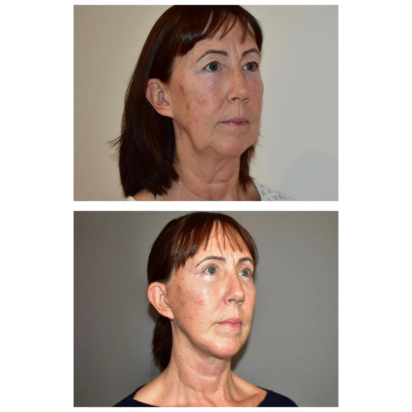 Another brilliant result of a Facelift and Upper and Lower Blepharoplasty. 

This procedure removes excess skin and fat on these facial areas, and tightens the remaining skin and tissues for a smoother and younger-looking appearance. 

Blepharoplasty