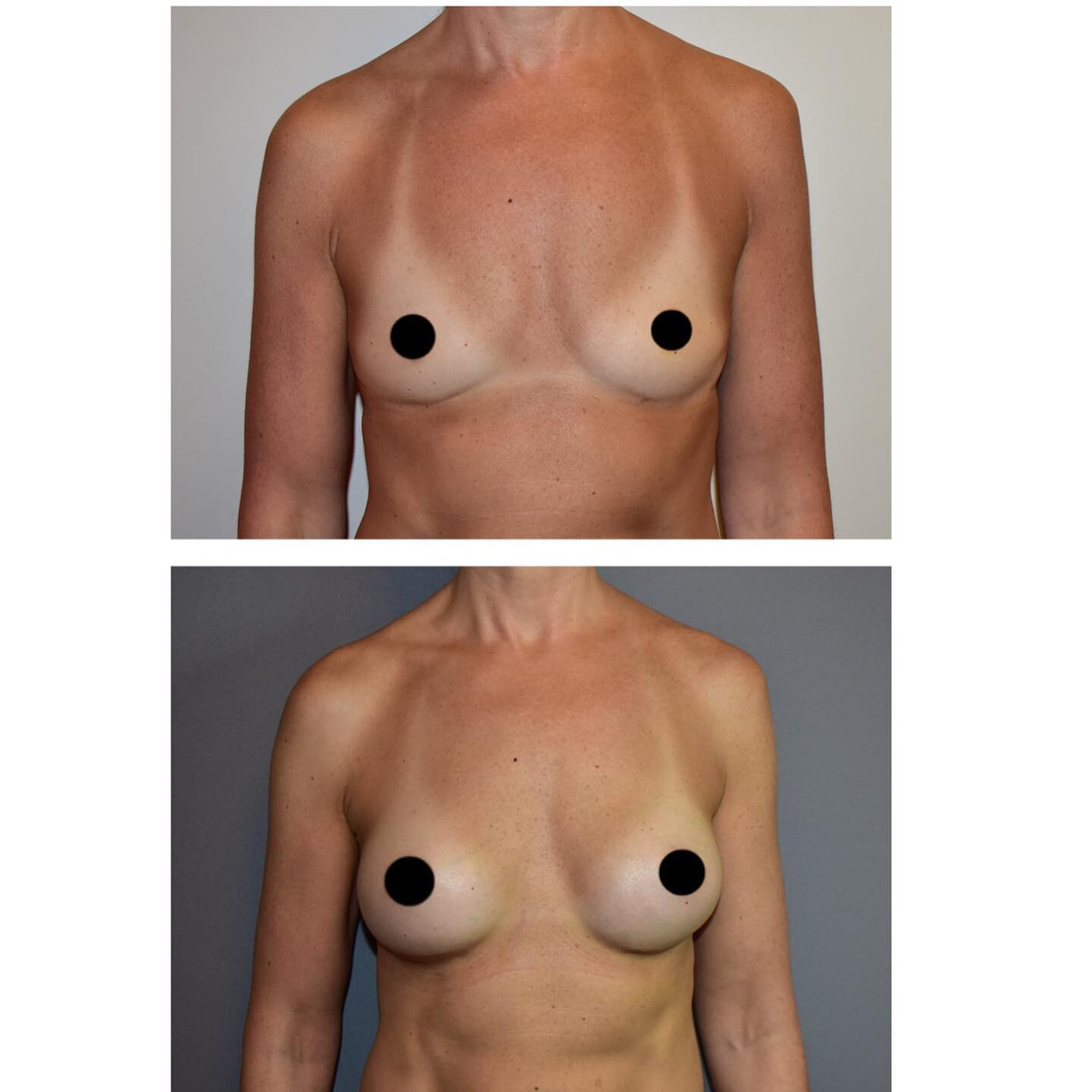 Breast Augmentation using 230cc tear drop polytech moderate profile implants.

Mr Carver uses shaped implants to give you the most natural looking breast.
As you can see from these photos this lovely patient has a great result.

If Breast Augmentatio