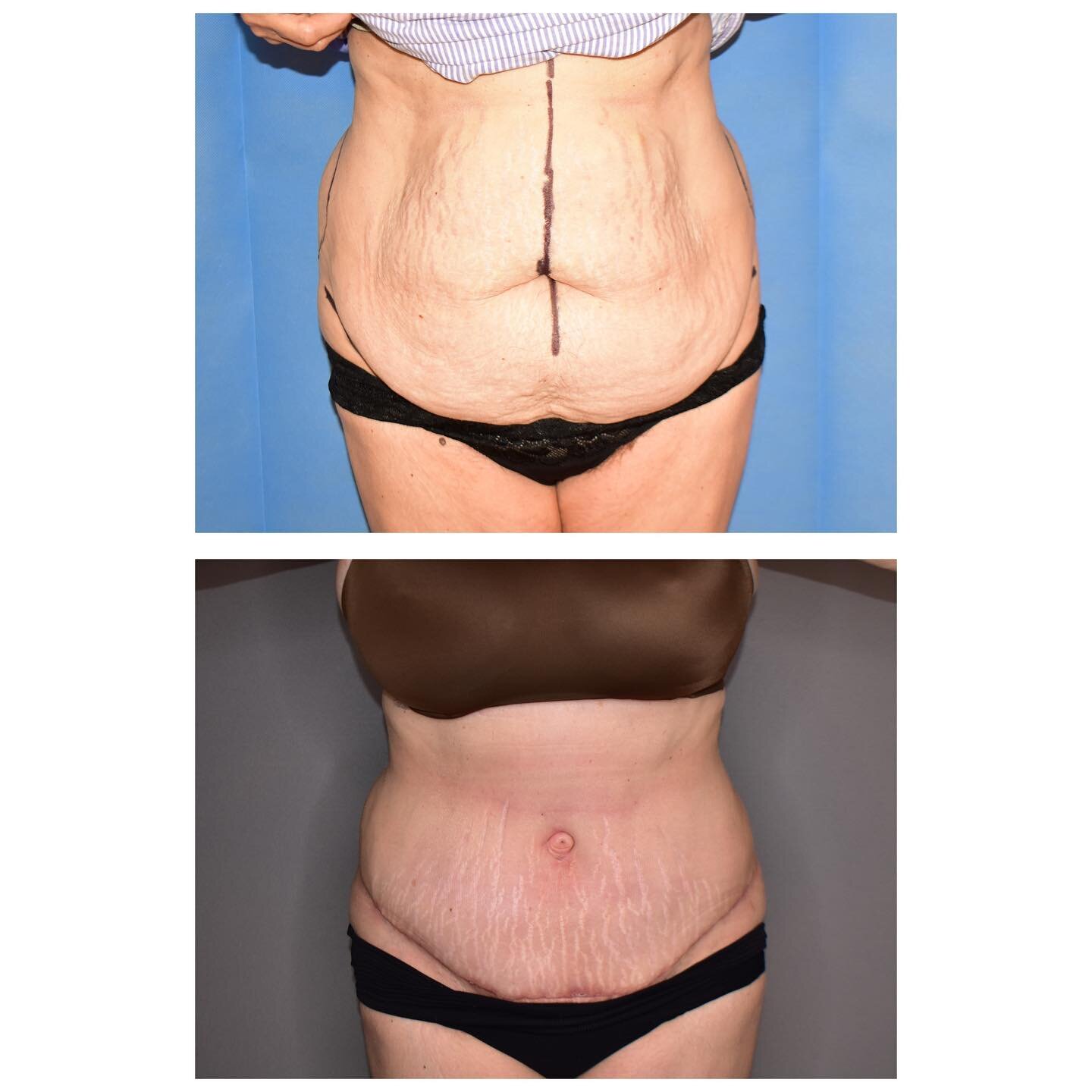 Abdominoplasty before and after only 6 weeks post op.

Unfortunately no amount of exercise or diet will change a over hang of tummy due to childbirth, age or weight loss.

Please contact Mr Carvers&rsquo; secretary sky@nigelcarver.co.uk for all enqui