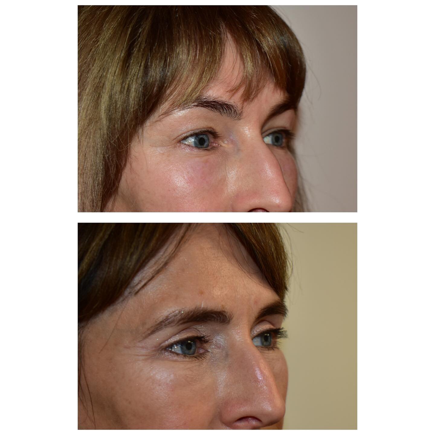 Fantastic results of an Upper and Lower Blepharoplasty performed by Mr Carver. 

These photos are taken around 8 weeks after surgery. 

#blepharoplasty#eyesurgery#lookyounger#confidence#transformation#plasticsurgery#cosmeticsurgery#consultation#amazi