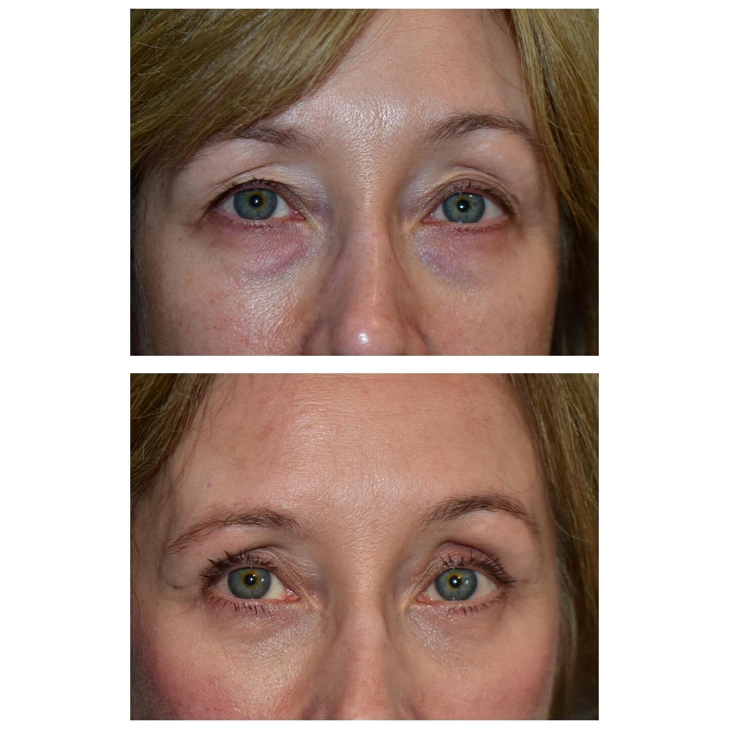 Upper and Lower Blepharoplasty performed by Mr Carver.

These before and after photos show how eye surgery can give you more youthful look and confidence. 

Blepharoplasty is performed under general anaesthetic with one night stay in hospital.

If yo