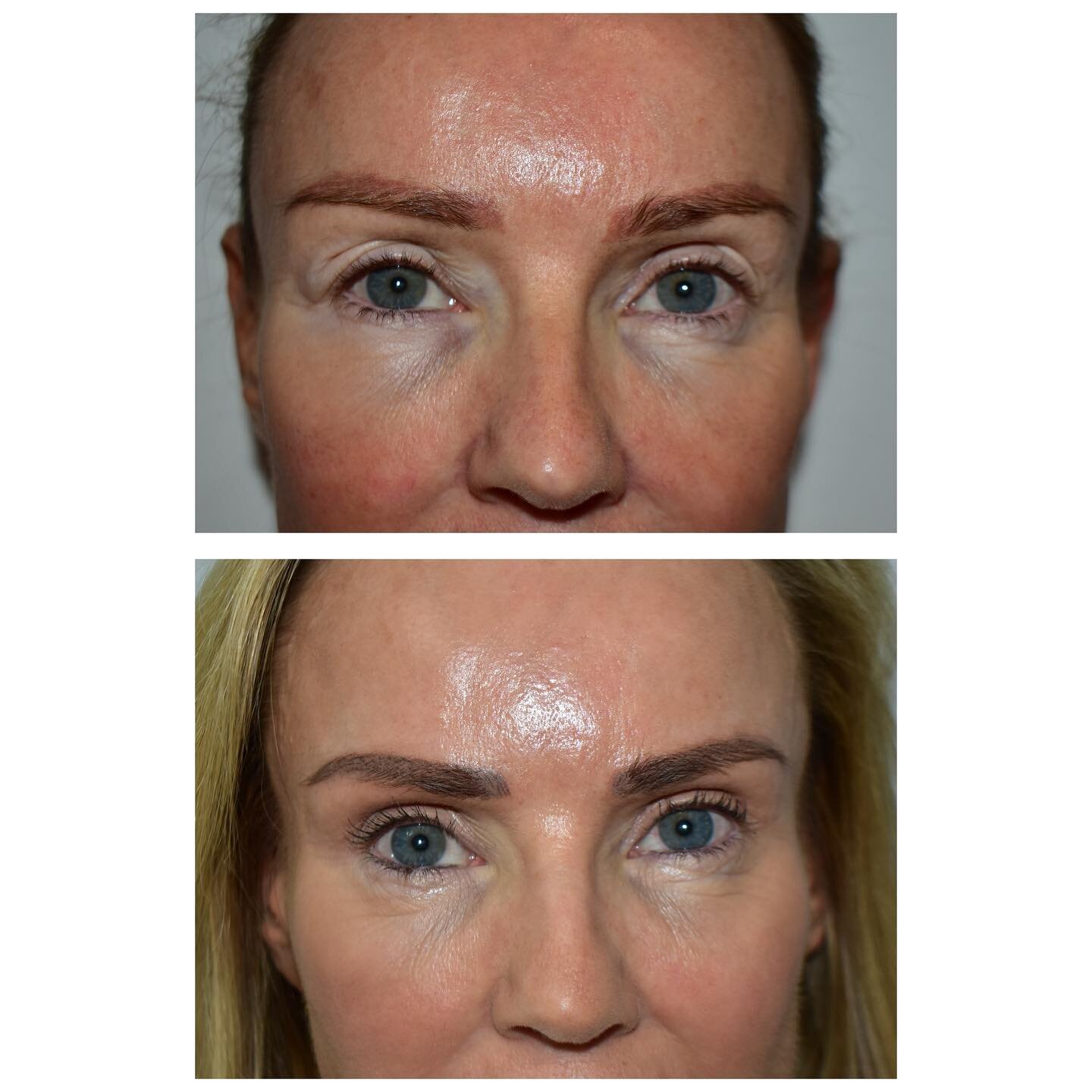Upper and Lower Blepharoplasty.

The operation to correct premature ageing of the eyelids is called Blepharoplasty.

It involves very careful removal of excess skin and fat of the upper and lower lids, both leaving very fine lines which are not visib
