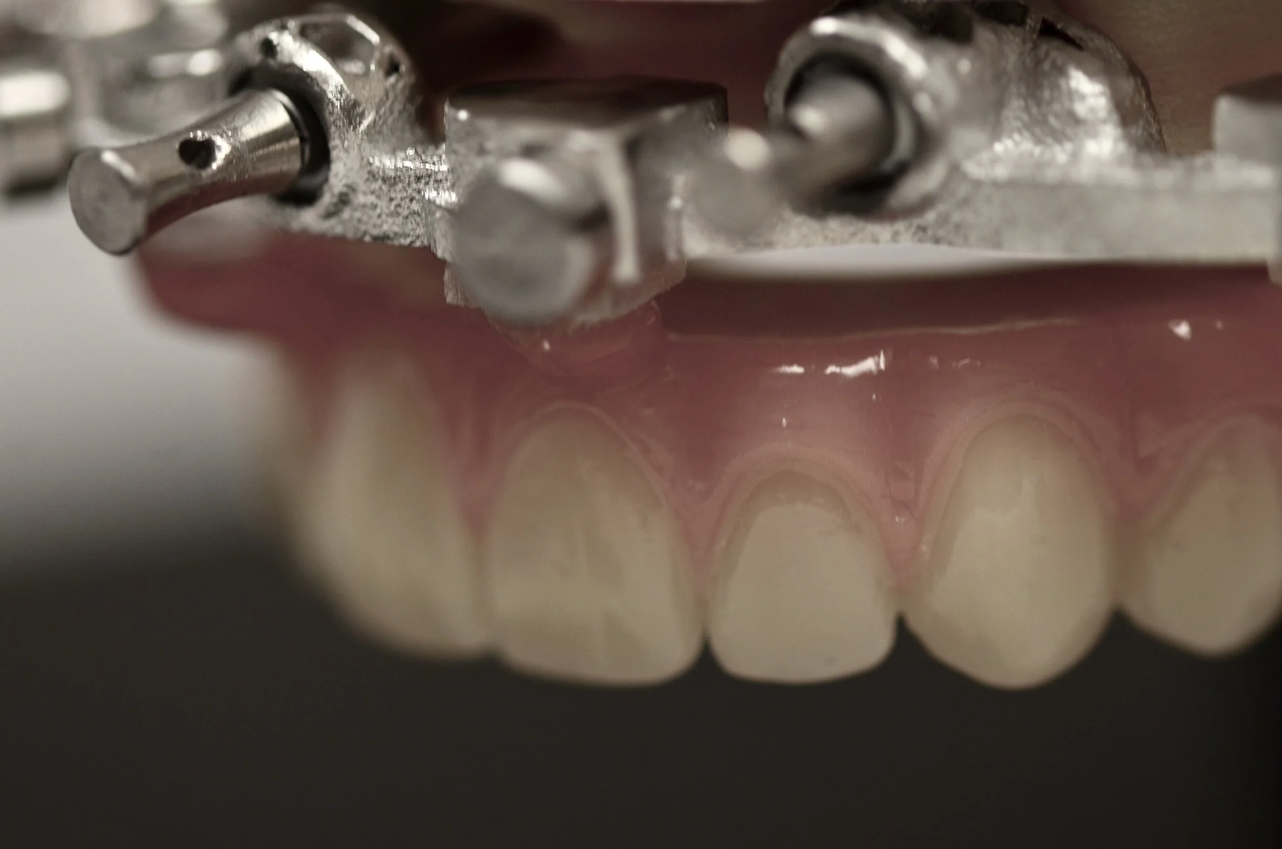 Conversion Prothese Conversion (FD) — Allure All On X Guided Workflow