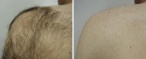 Comparison of a hairy and smooth shoulder, showing hair removal results.