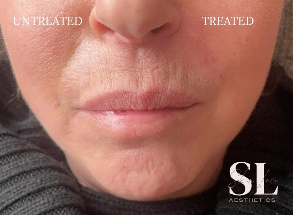 Small adjustments. Big difference.
Nasolabial fold treatment to restore softness without changing expression.
Natural results always come first.
Message to book ✨

#aestheticsherts #aestheticshertfordshire #fillerhertfordshire #aestheticsstalbans