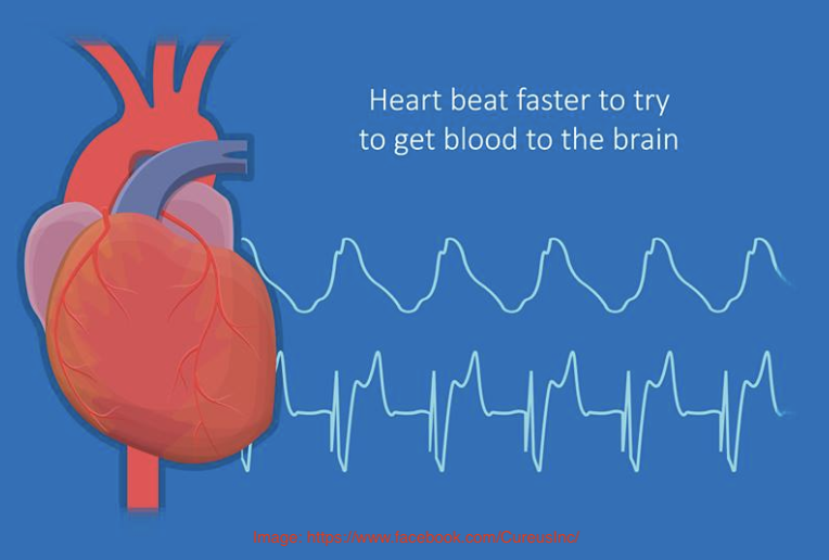 Postural Orthostatic Tachycardia Syndrome (POTS) and Long COVID