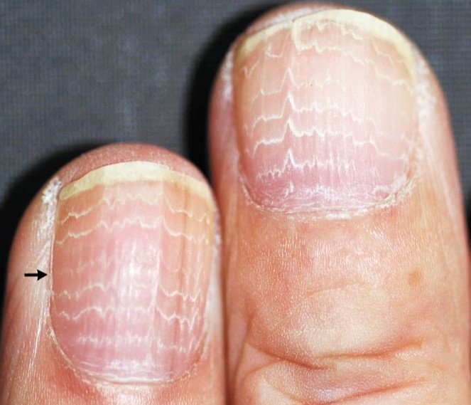 Bizarre white lines on man's fingernails turned out to be a sign of his  CANCER drugs - as doctors say nails can be a window into your health |  Daily Mail Online