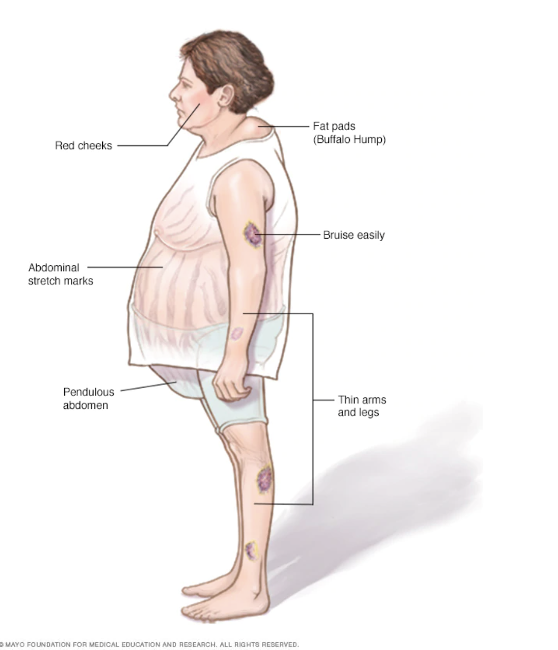 Endogenous Cushing S Syndrome Sparrow Pharmaceuticals