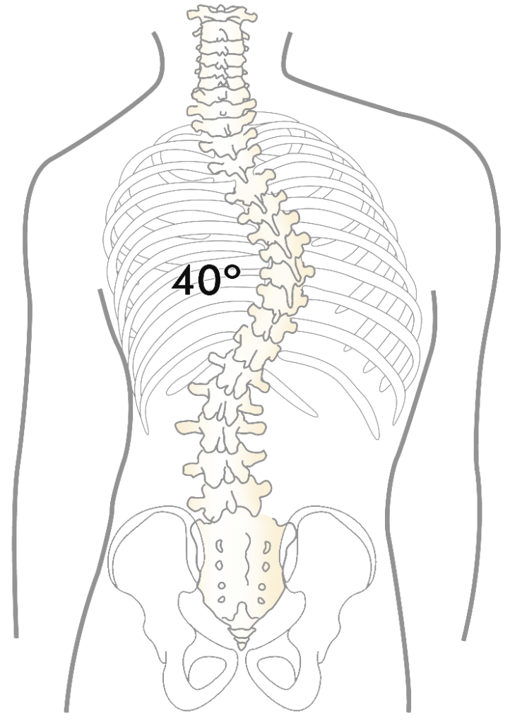 what-is-scoliosis-739x1024.png