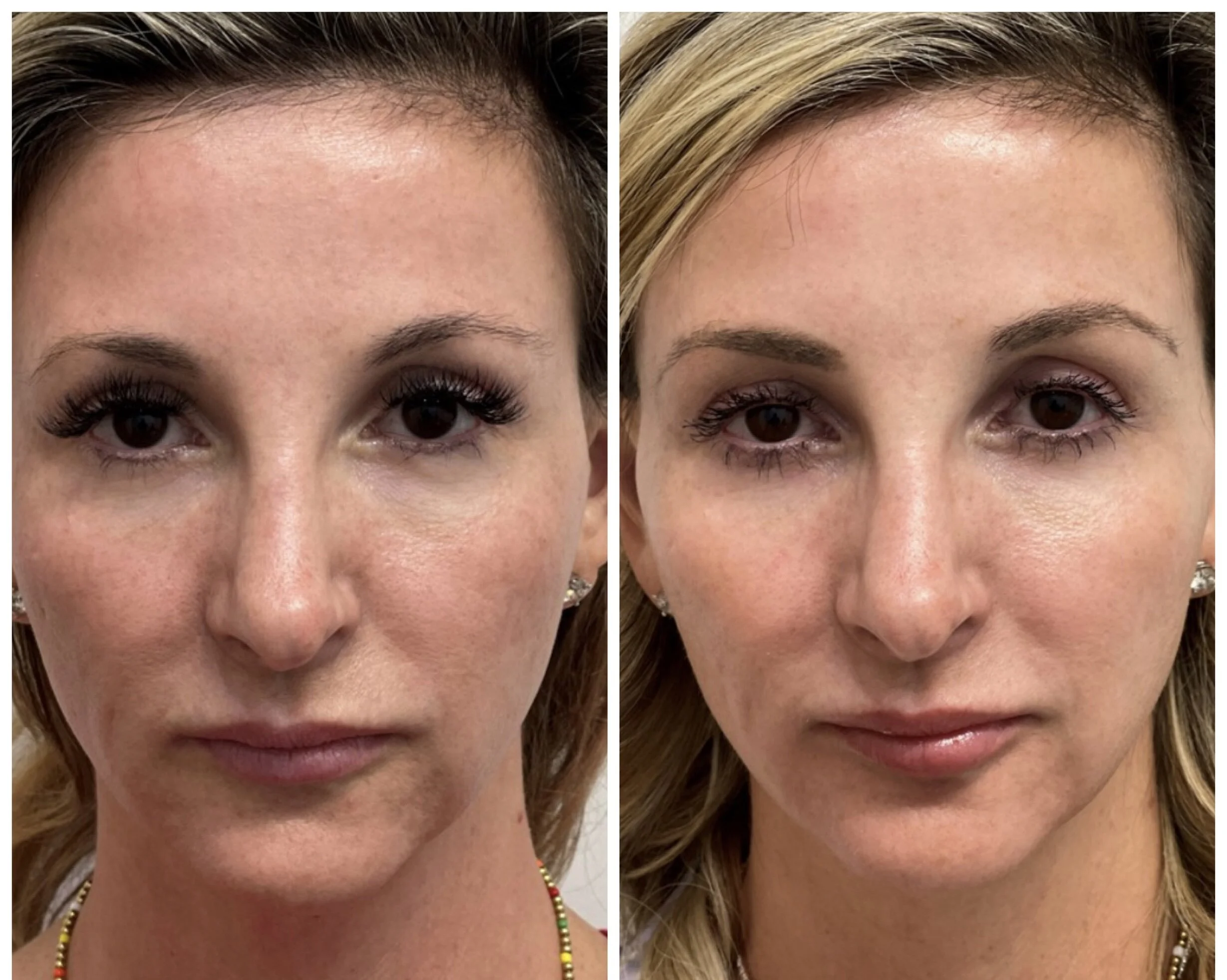 You Have To See Sophie Rain'S Bbl Before & After! - 5ub8pti