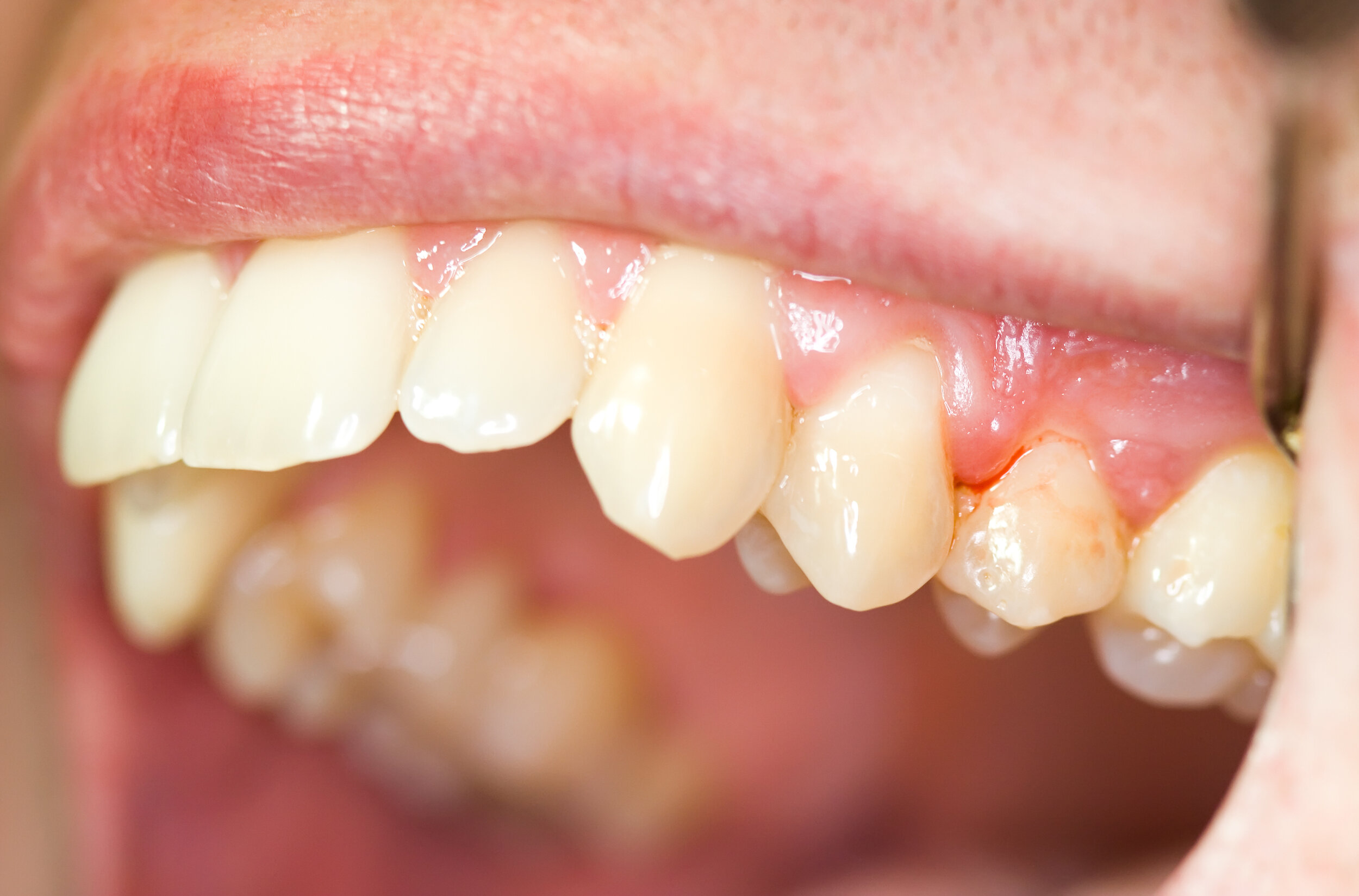 Ontstoken tandvlees genezen — ParoBreda Praktijk voor parodontologie en Breda
