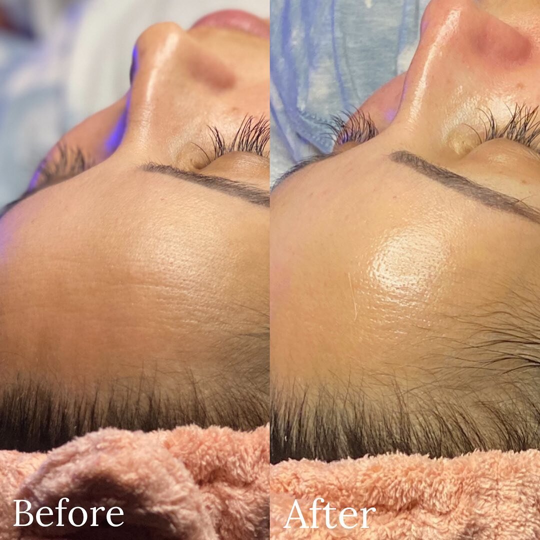 If your wanting clearer skin, unclogged pores, better overall skin texture, help with discoloration....✨Hydrafacial✨is the answer! All scheduling is done online at www.soffittaskincare.com✨DM with any questions or inquiries!  #soffitta #soffittaskinc