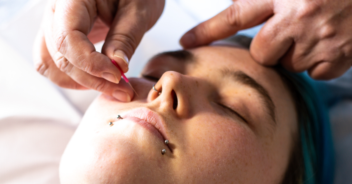 Close up of a facial acupuncture treatment