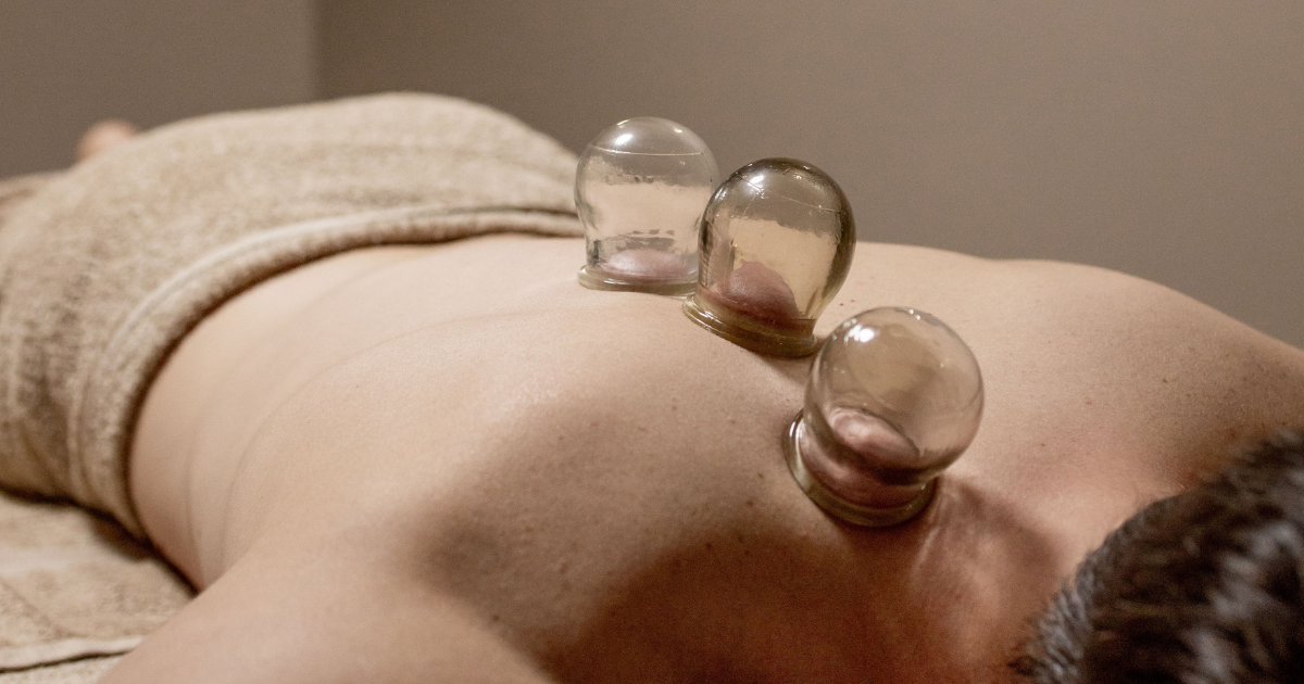 Cupping therapy treatment on the body