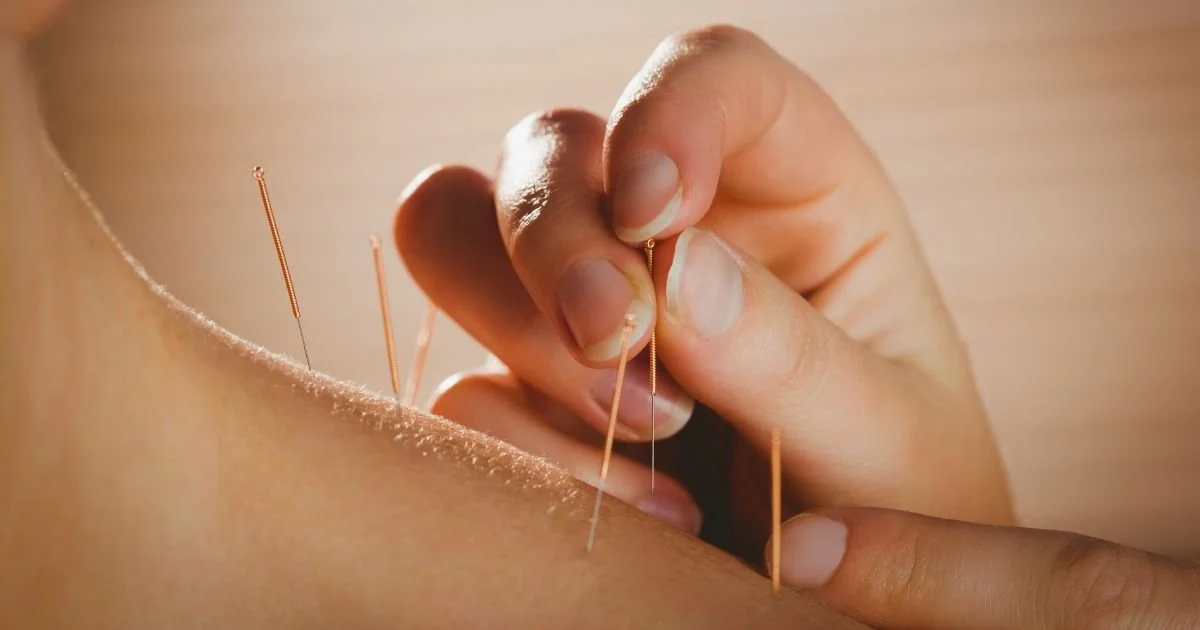 Acupuncture for Stress and Burnout: What It Actually Does