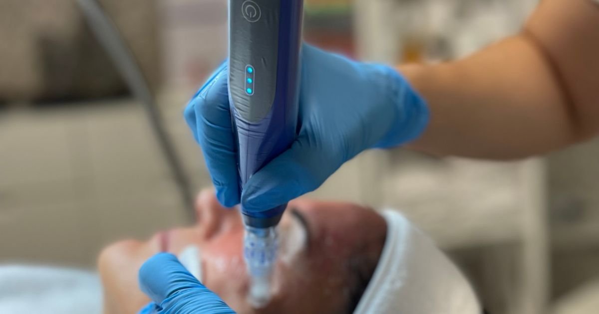 Professional microneedling treatment