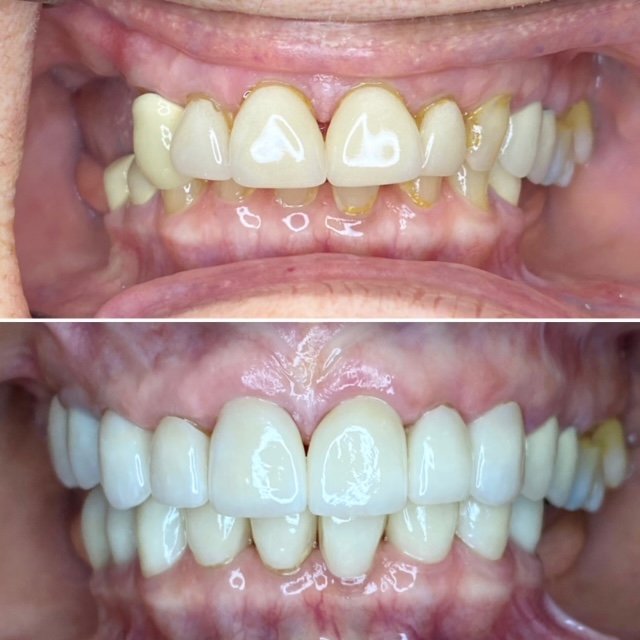 Full Mouth Crowns