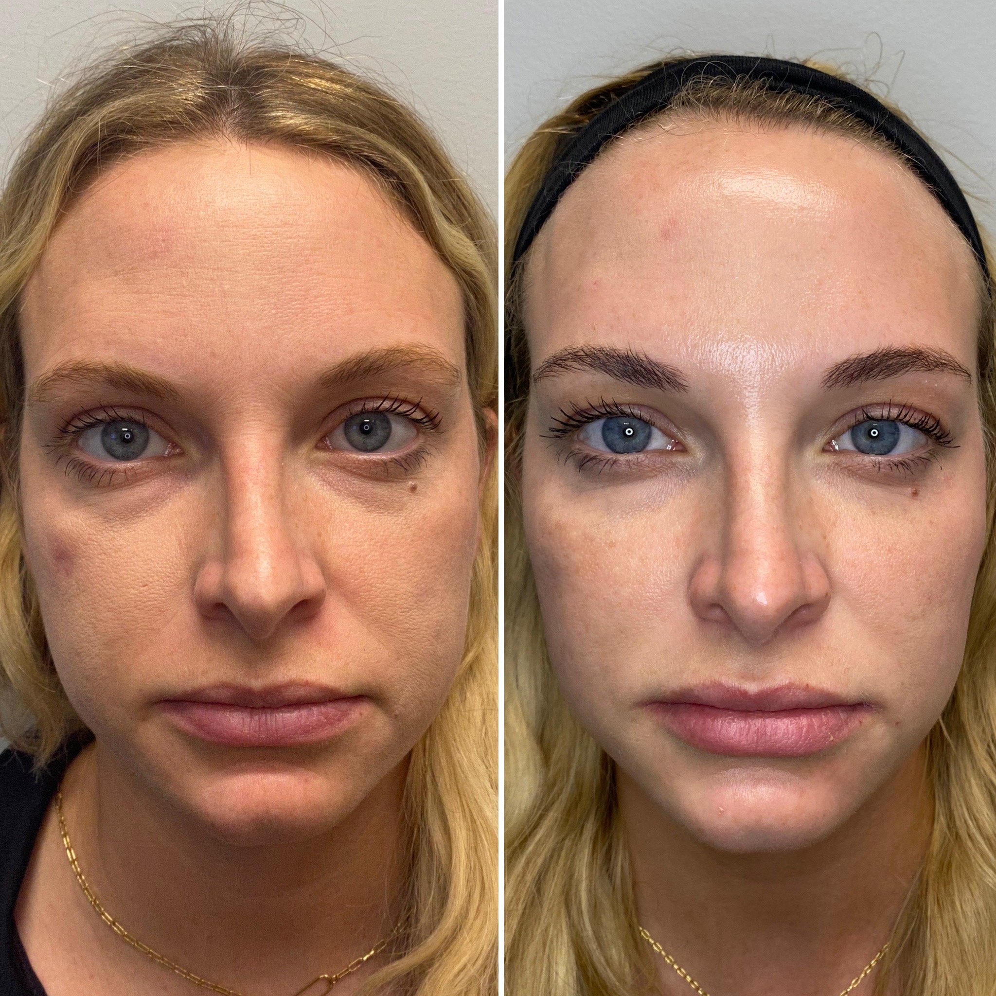 Undereyes, Cheeks, & Subtle Lips