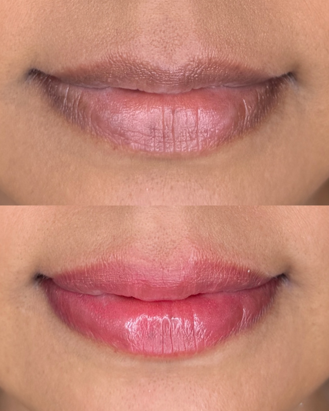 Before/ Immediately After Procedure