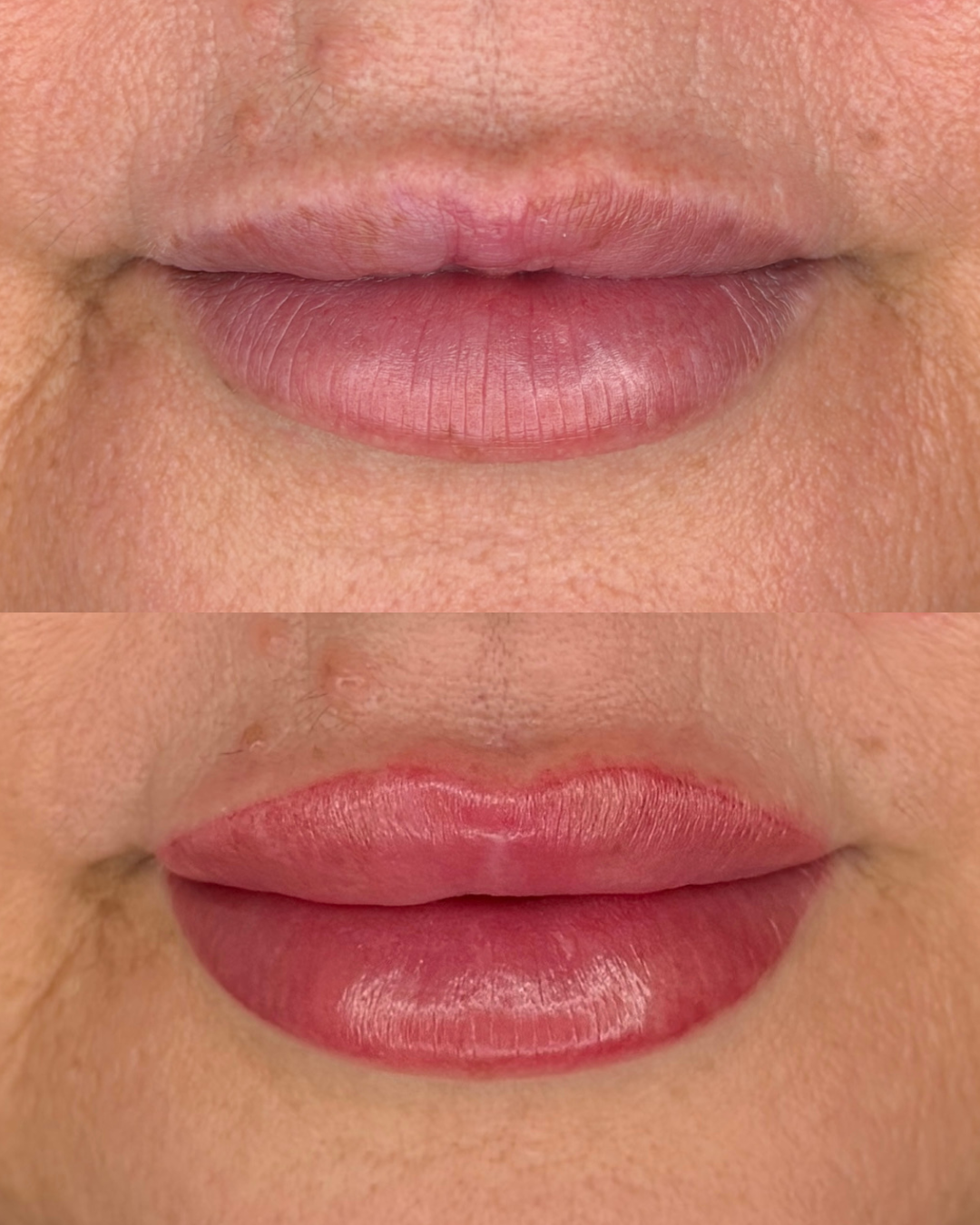 Before/ Immediately After Procedure