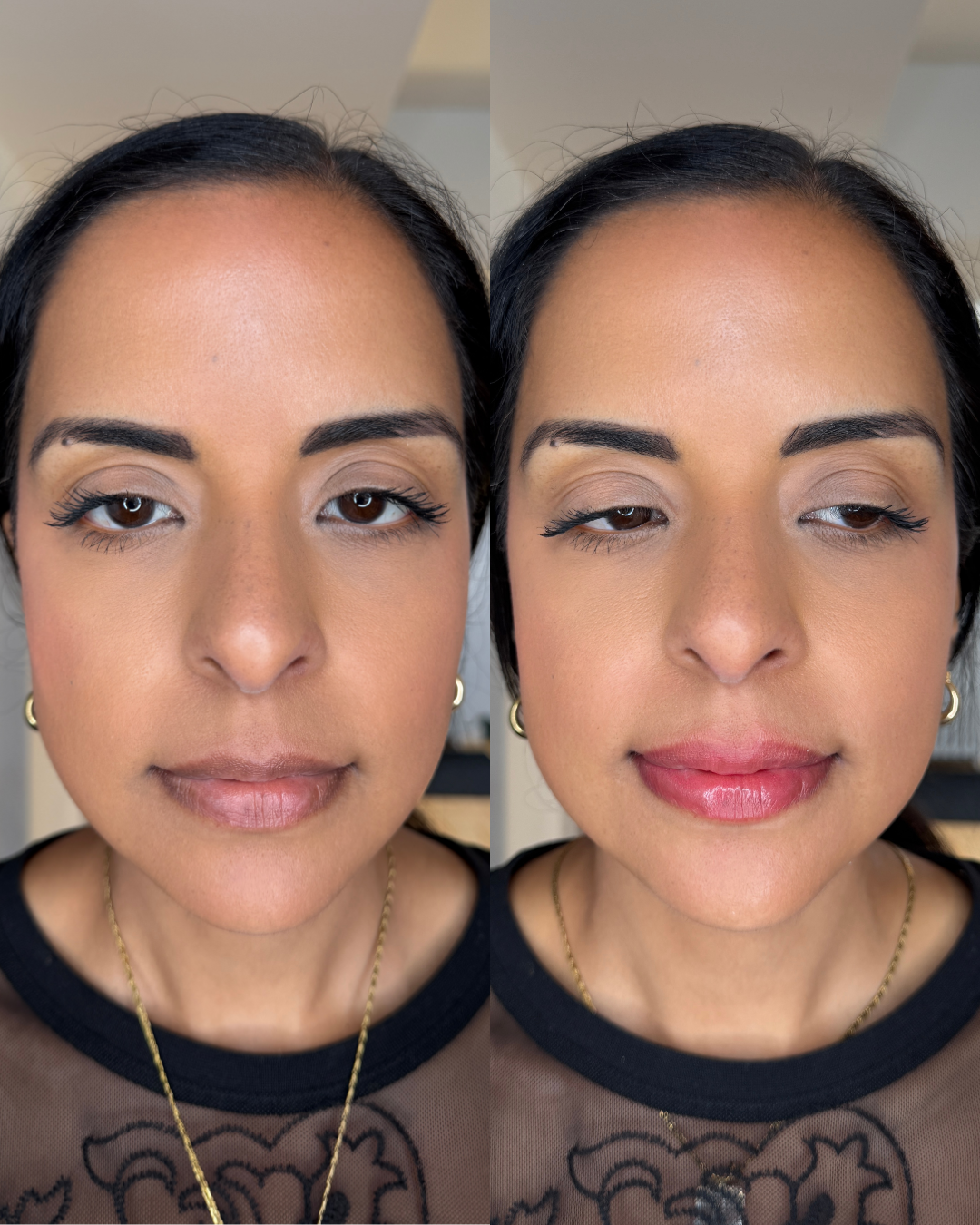 Before/ Immediately After Procedure