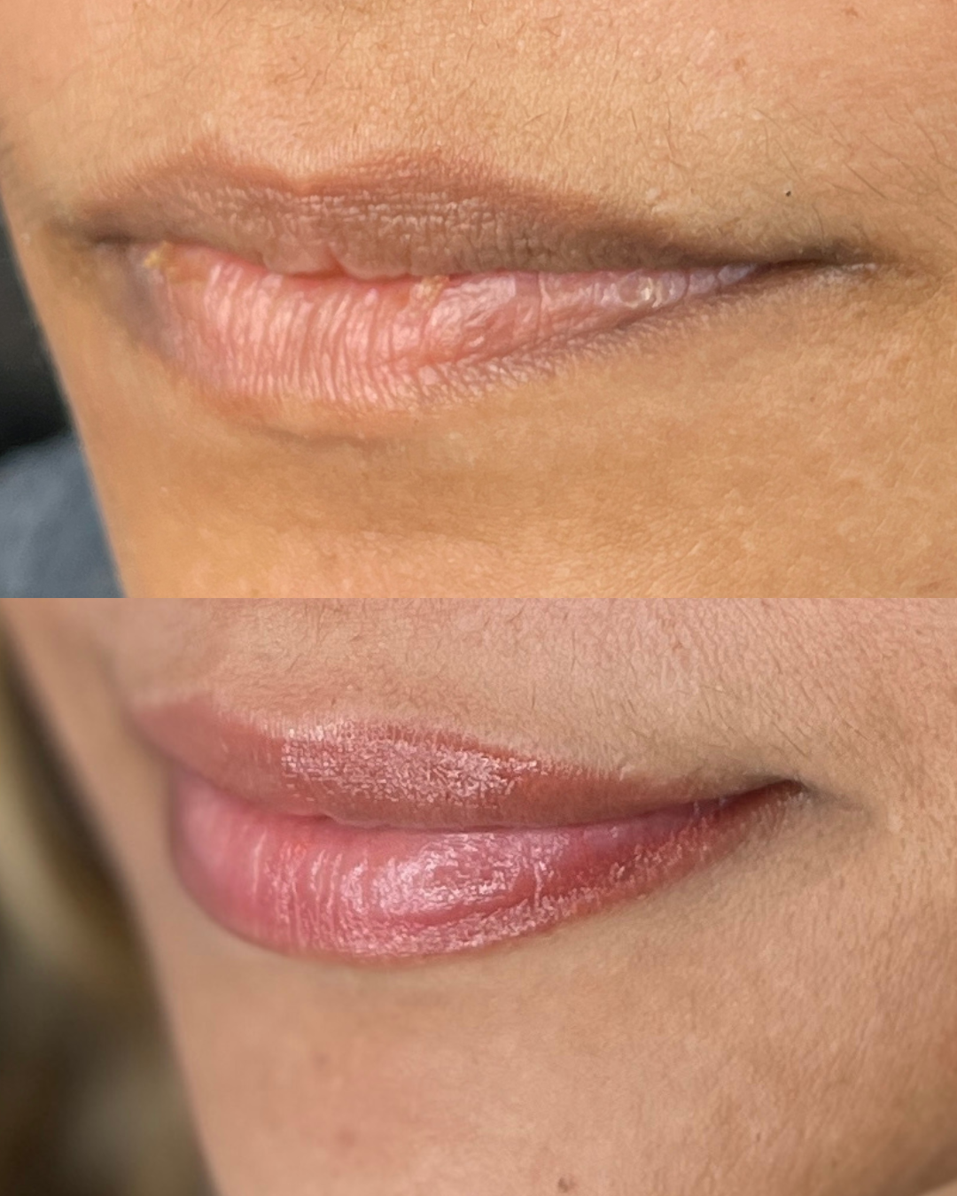 Before/ Immediately After Procedure
