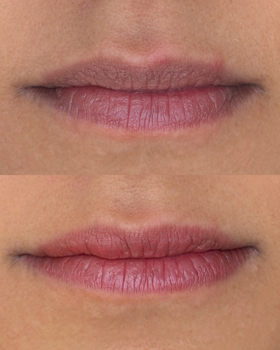 Lip Neutralization - Before/ Immediately After