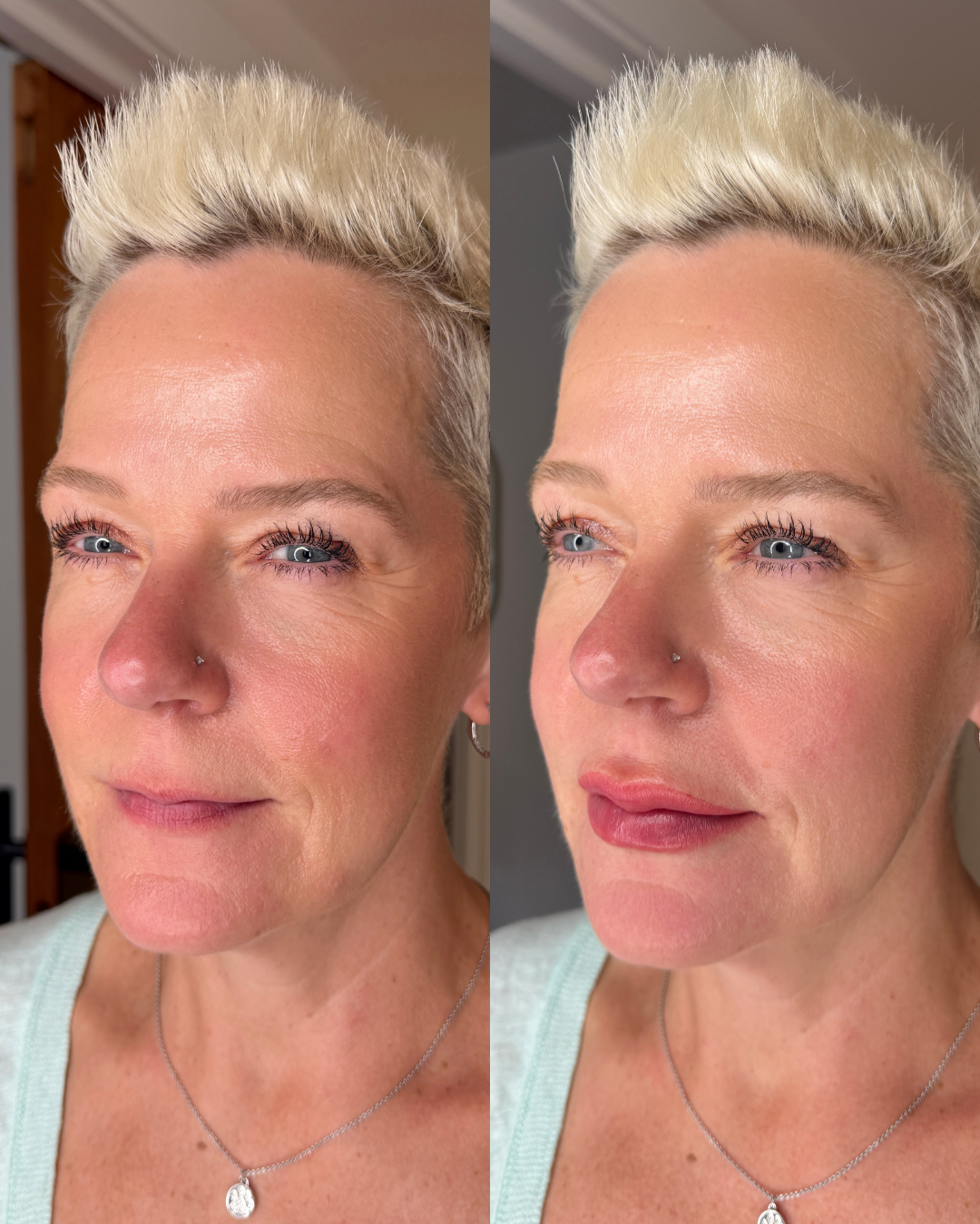 Before/ Immediately After Procedure