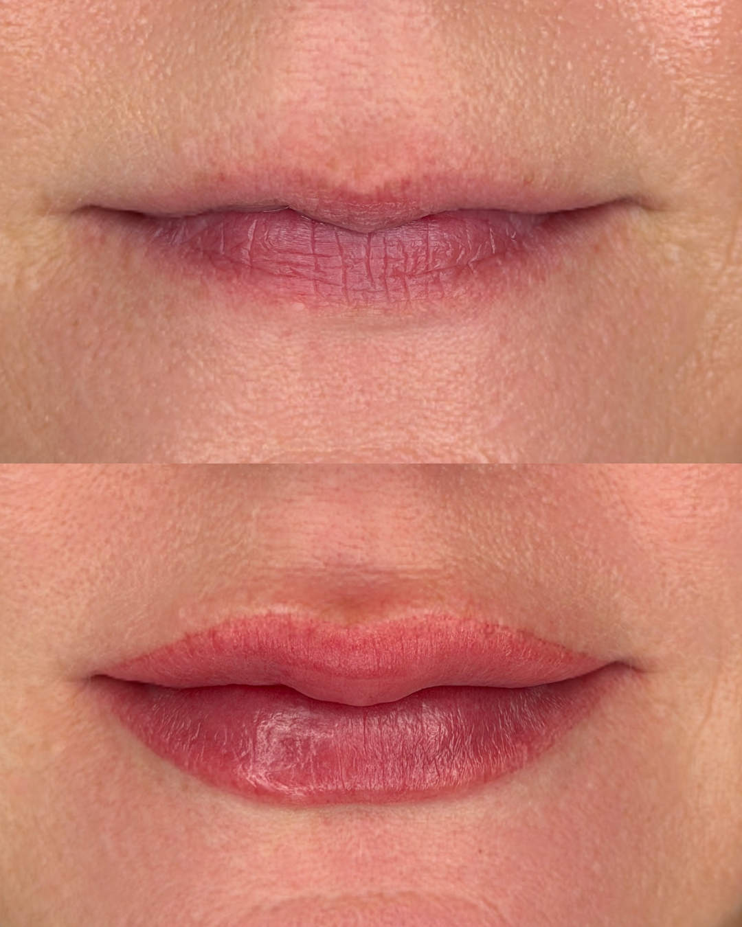 Before/ Immediately After Procedure
