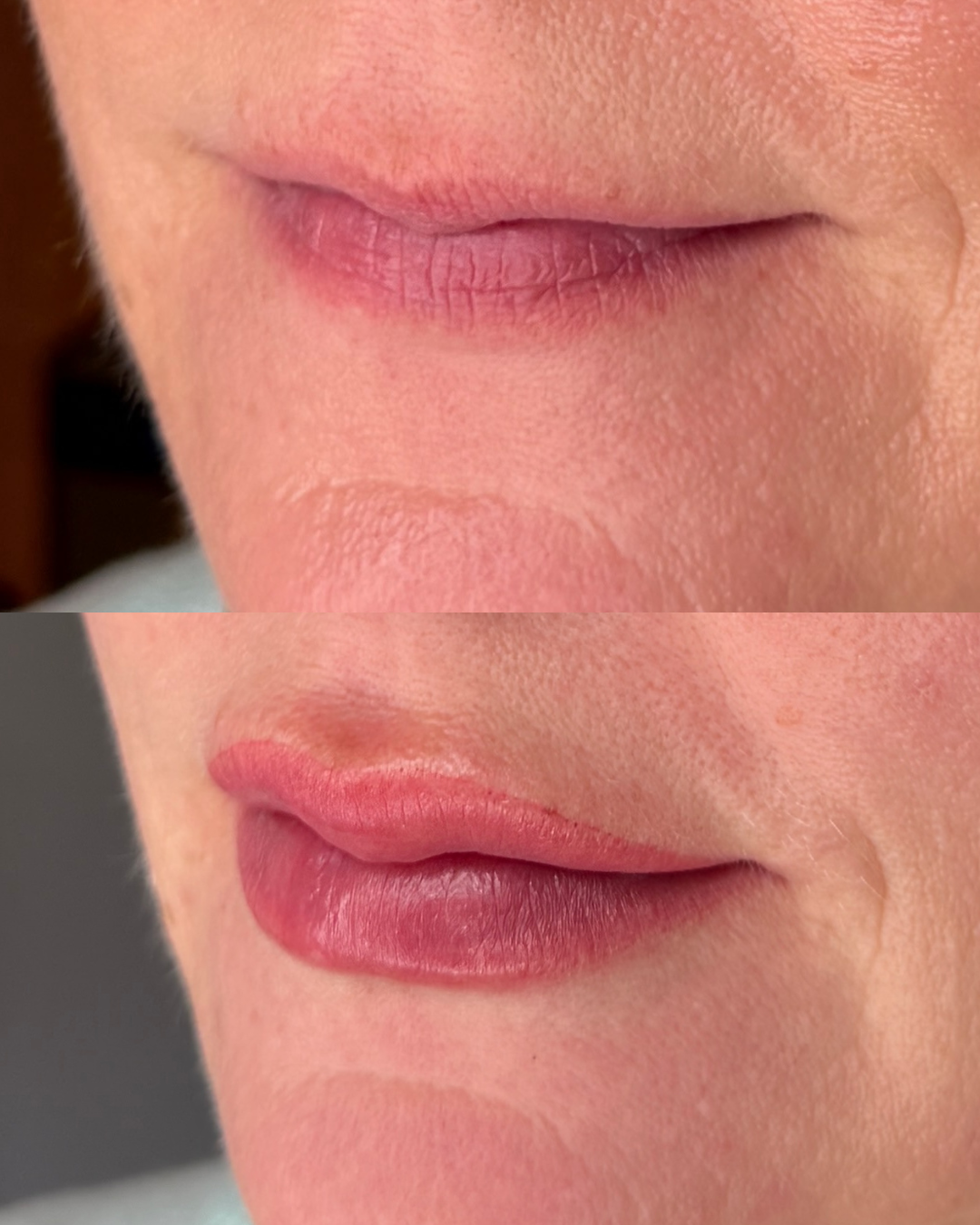 Before/ Immediately After Procedure