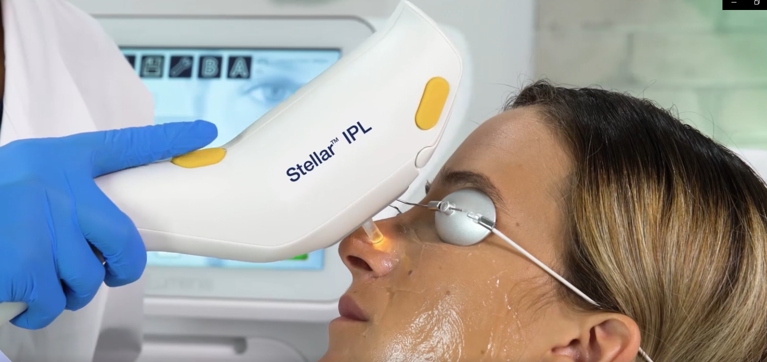 From the inventors of Intense Pulsed Light (IPL) and pioneers of CO2 fractional laser, we are now offering the world class Lumines laser treatments for complete complexion improvement.
Reduce pigmentation and uneven skin tone, heal redness, rosacea a