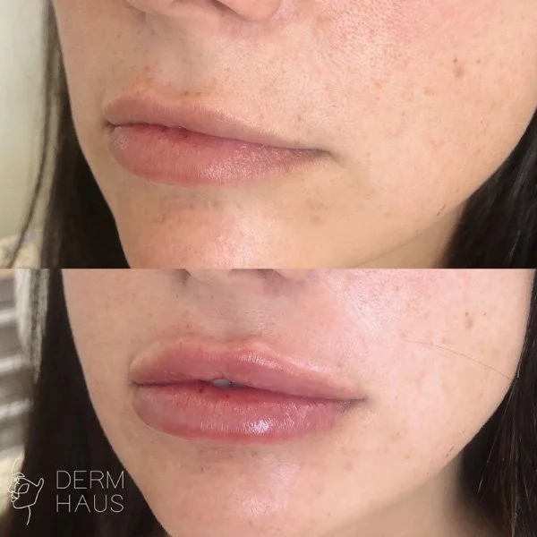 Brisbane's Top Rated Lip Filler Clinic Derm Haus Brisbane