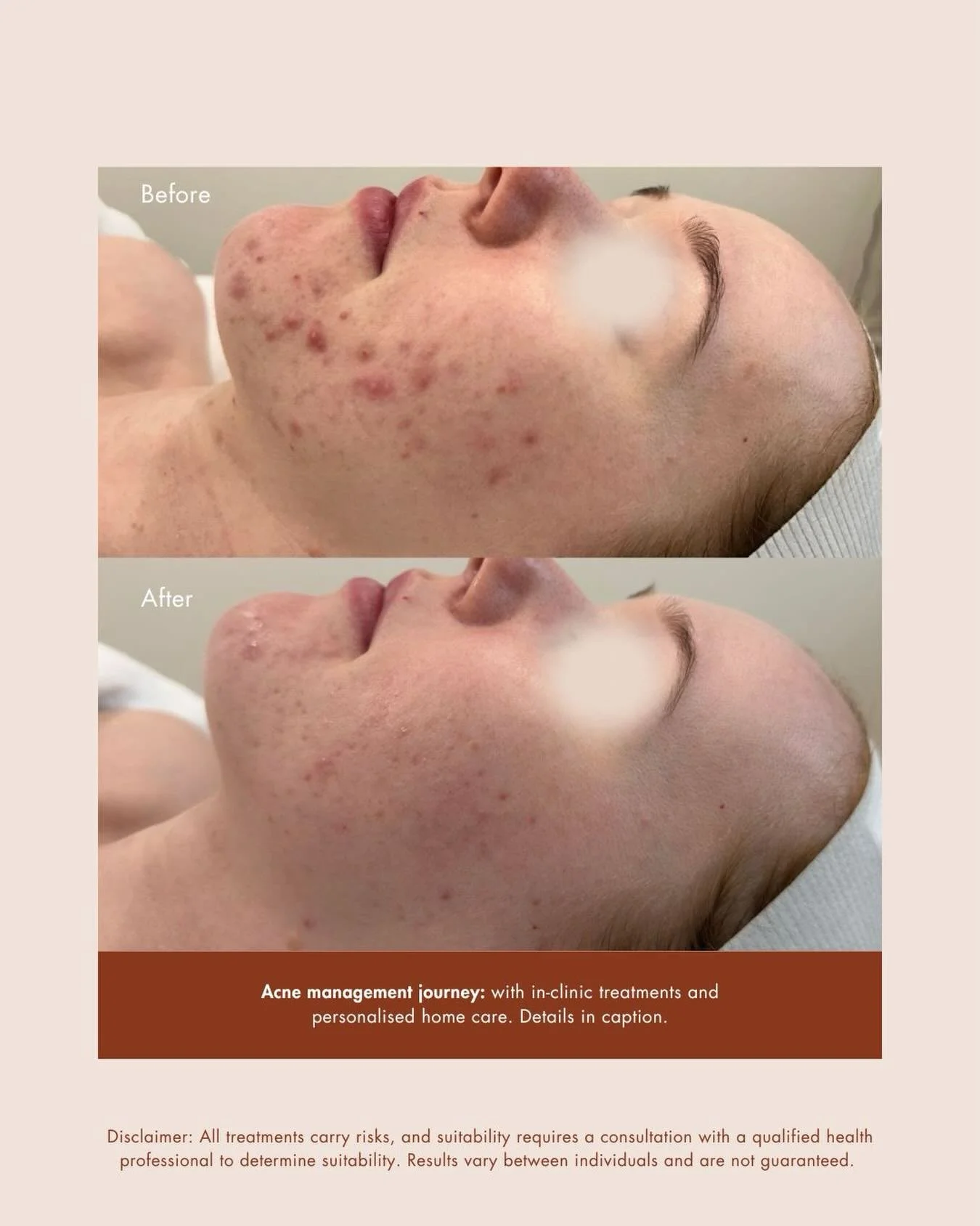 How did we get this result?👇

With 3x DMK level 1 enzymes and 2x skin needling with a customised home skincare plan of @isclinical_anz and @dmkskin 

We can&rsquo;t wait to continue supporting this wonderful patient on their skin journey.

&zwnj;
Th